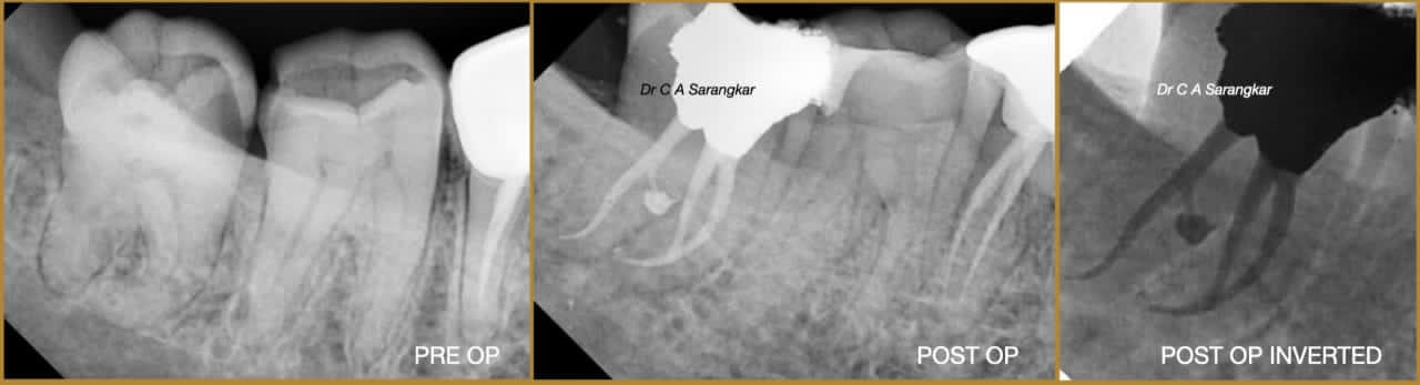 CLINICAL CASE BY Dr Chandrakant A Sarangkar​